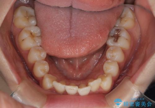 【インビザライン】マウスピースで開咬改善の治療前