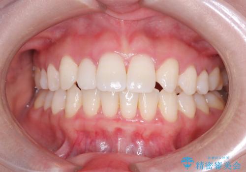 軽度の歯のデコボコ(叢生)をインビザライン(マウスピース)で改善|わずか5か月で整った歯並びにの治療後