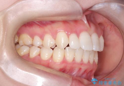 軽度の歯のデコボコ(叢生)をインビザライン(マウスピース)で改善|わずか5か月で整った歯並びにの治療後