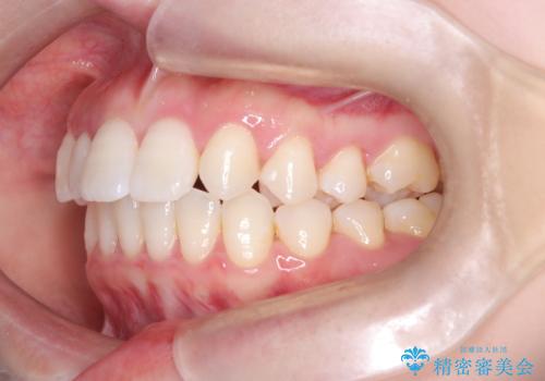 軽度の歯のデコボコ(叢生)をインビザライン(マウスピース)で改善|わずか5か月で整った歯並びにの治療後