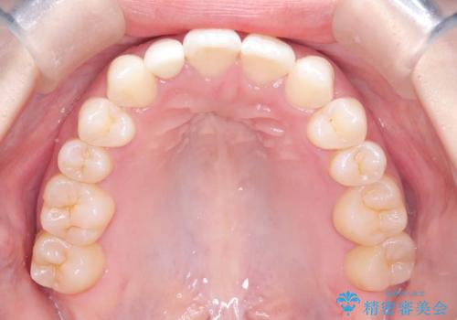 軽度の歯のデコボコ(叢生)をインビザライン(マウスピース)で改善|わずか5か月で整った歯並びにの治療後