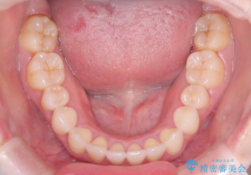 軽度の歯のデコボコ(叢生)をインビザライン(マウスピース)で改善|わずか5か月で整った歯並びにの治療後