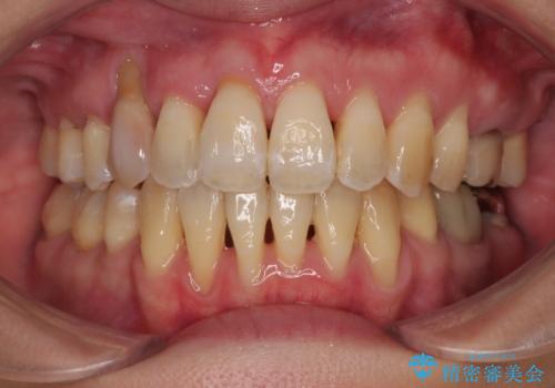 急速拡大装置 狭い骨幅を拡大した上で、顕著なデコボコを改善する抜歯矯正治療の症例 治療後