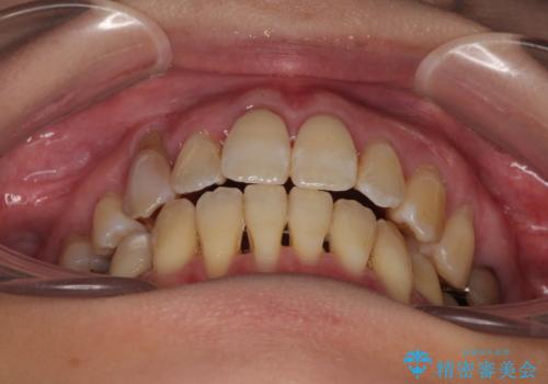 急速拡大装置 狭い骨幅を拡大した上で、顕著なデコボコを改善する抜歯矯正治療の治療後