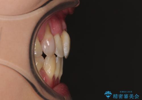 急速拡大装置 狭い骨幅を拡大した上で、顕著なデコボコを改善する抜歯矯正治療の治療後