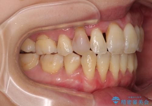 急速拡大装置 狭い骨幅を拡大した上で、顕著なデコボコを改善する抜歯矯正治療の治療後