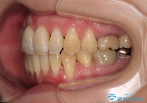 急速拡大装置 狭い骨幅を拡大した上で、顕著なデコボコを改善する抜歯矯正治療の治療後