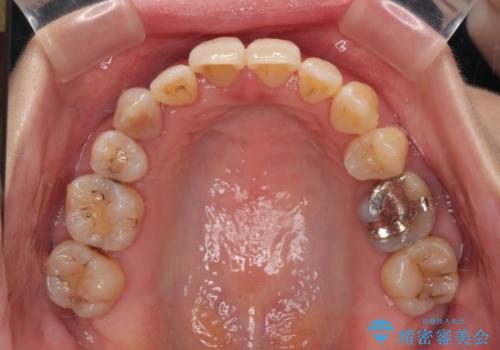 急速拡大装置 狭い骨幅を拡大した上で、顕著なデコボコを改善する抜歯矯正治療の治療後