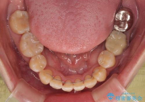 急速拡大装置 狭い骨幅を拡大した上で、顕著なデコボコを改善する抜歯矯正治療の治療後