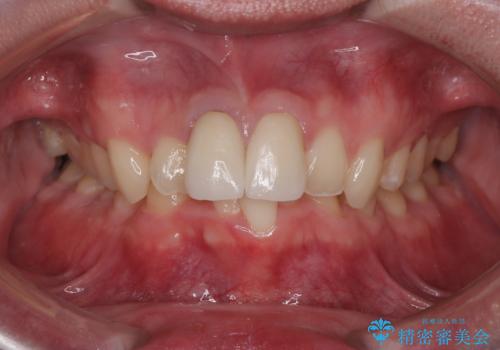 保険治療後の見た目が気になる方へ|セラミッククラウンで美しく自然な仕上がりにの治療後