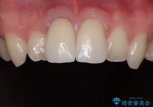 保険治療後の見た目が気になる方へ|セラミッククラウンで美しく自然な仕上がりにの治療後