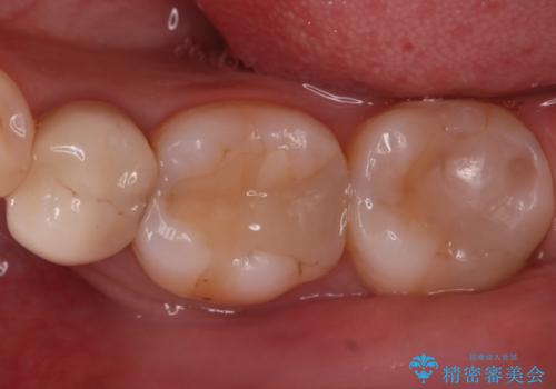 奥歯に虫歯があると言われた セラミッククラウンでキレイで長持ちする歯への治療前