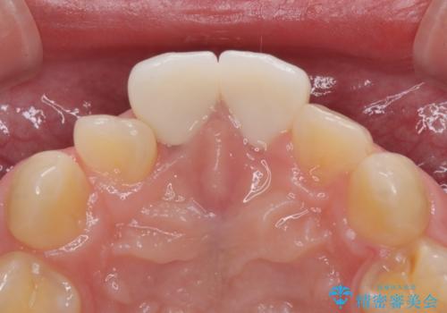 保険治療後の見た目が気になる方へ|セラミッククラウンで美しく自然な仕上がりにの治療後
