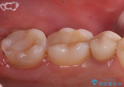 奥歯に虫歯があると言われた セラミッククラウンでキレイで長持ちする歯への症例 治療前