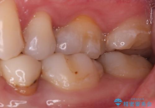 奥歯に虫歯があると言われた セラミッククラウンでキレイで長持ちする歯への治療前