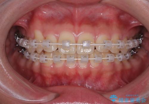 マウスピース矯正が煩わしい ワイヤー装置での非抜歯矯正の治療中