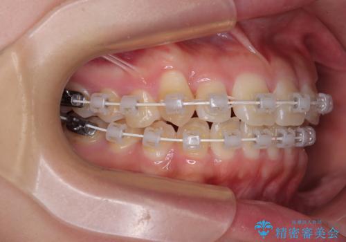 マウスピース矯正が煩わしい ワイヤー装置での非抜歯矯正の治療中