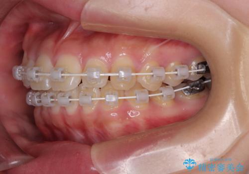マウスピース矯正が煩わしい ワイヤー装置での非抜歯矯正の治療中
