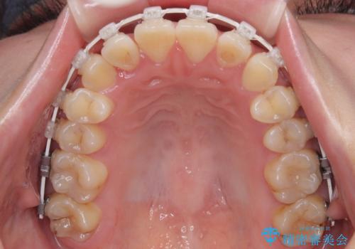 マウスピース矯正が煩わしい ワイヤー装置での非抜歯矯正の治療中