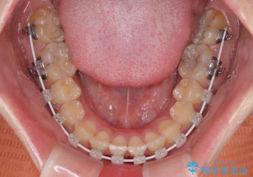 マウスピース矯正が煩わしい ワイヤー装置での非抜歯矯正の治療中