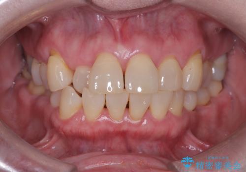 前歯の隙間とへこみが舌で触ると気になる|矯正治療は絶対にしたくない|抜歯即時インプラント+オールセラミッククラウンで審美修復