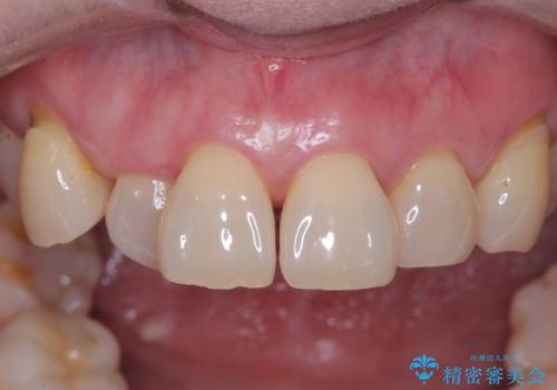 前歯の隙間とへこみが舌で触ると気になる|矯正治療は絶対にしたくない|抜歯即時インプラント+オールセラミッククラウンで審美修復の症例 治療前