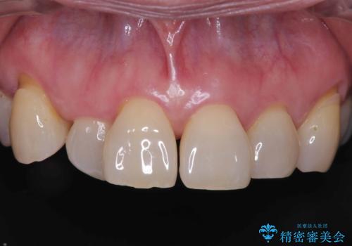 前歯の隙間とへこみが舌で触ると気になる|矯正治療は絶対にしたくない|抜歯即時インプラント+オールセラミッククラウンで審美修復の治療前