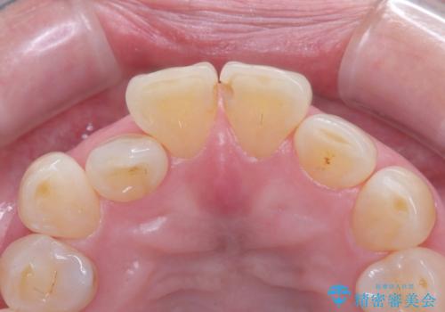 前歯の隙間とへこみが舌で触ると気になる|矯正治療は絶対にしたくない|抜歯即時インプラント+オールセラミッククラウンで審美修復の治療前