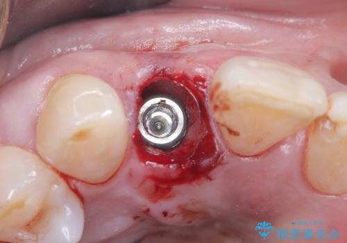 前歯の隙間とへこみが舌で触ると気になる|矯正治療は絶対にしたくない|抜歯即時インプラント+オールセラミッククラウンで審美修復の治療中