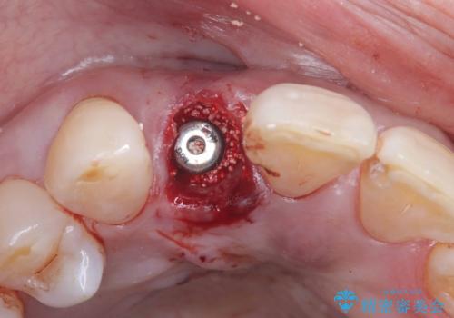 前歯の隙間とへこみが舌で触ると気になる|矯正治療は絶対にしたくない|抜歯即時インプラント+オールセラミッククラウンで審美修復の治療中