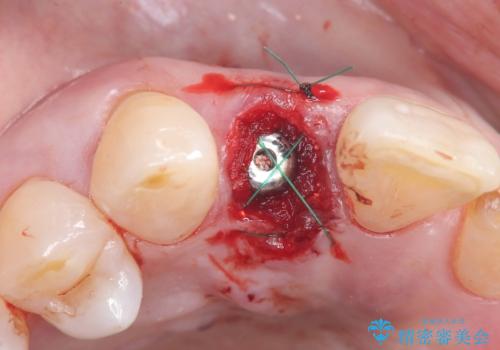 前歯の隙間とへこみが舌で触ると気になる|矯正治療は絶対にしたくない|抜歯即時インプラント+オールセラミッククラウンで審美修復の治療中