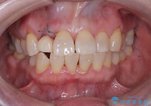 前歯の隙間とへこみが舌で触ると気になる|矯正治療は絶対にしたくない|抜歯即時インプラント+オールセラミッククラウンで審美修復の治療中