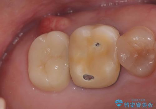 根尖性歯周炎|歯根嚢胞|インプラント治療の治療前