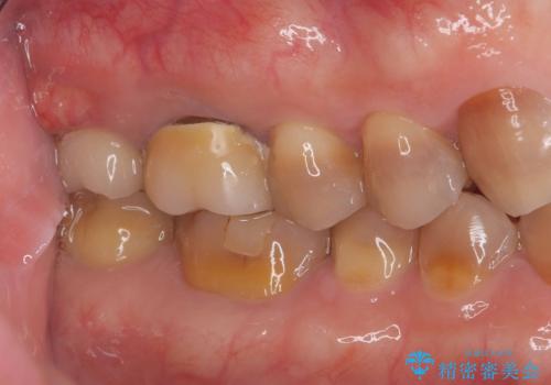 根尖性歯周炎|歯根嚢胞|インプラント治療の治療前