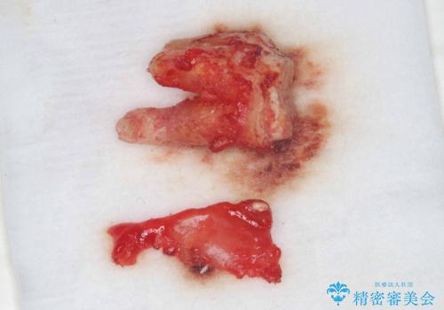 根尖性歯周炎|歯根嚢胞|インプラント治療の治療前