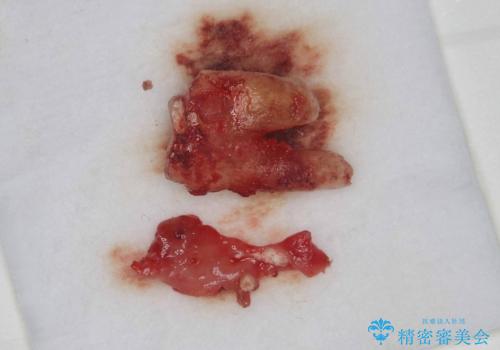 根尖性歯周炎|歯根嚢胞|インプラント治療