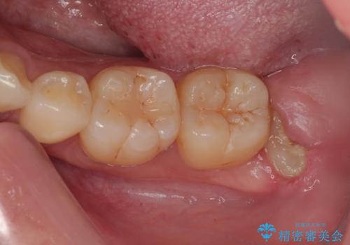 親知らずを抜きたい　親知らず抜歯の症例 治療前