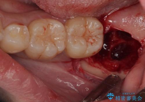 親知らずを抜きたい 親知らず抜歯の治療中