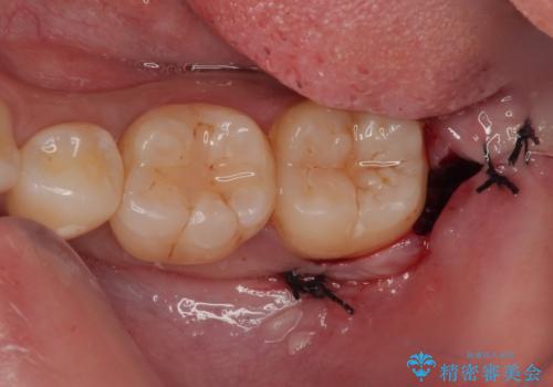 親知らずを抜きたい　親知らず抜歯の症例 治療後