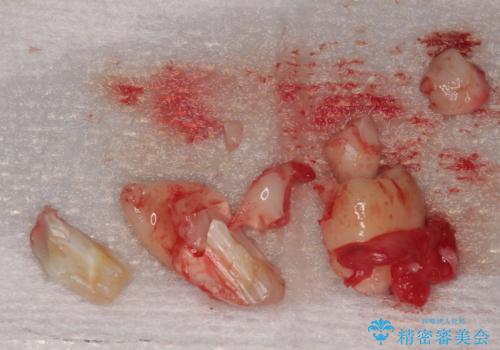 親知らずを抜きたい　親知らず抜歯の治療中