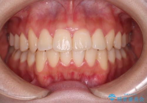 【インビザライン】マウスピースで開咬改善の症例 治療後