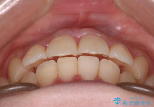 【インビザライン】マウスピースで開咬改善の治療後