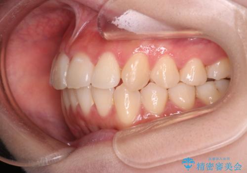 【インビザライン】マウスピースで開咬改善の治療後
