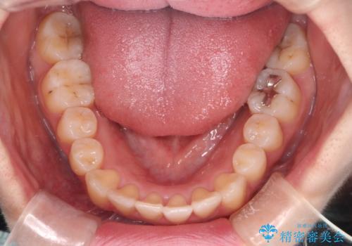 【インビザライン】マウスピースで開咬改善の治療後