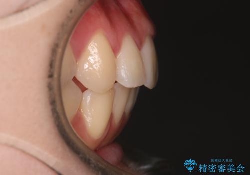 【インビザライン】マウスピースで開咬改善の治療後