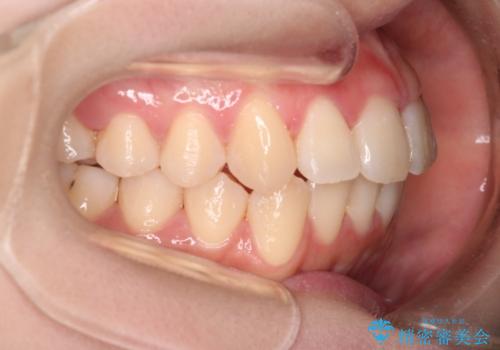 【インビザライン】マウスピースで開咬改善の治療後