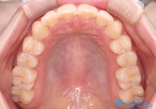 【インビザライン】マウスピースで開咬改善の治療後