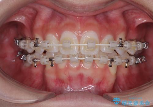 斜め前に飛び出した前歯 抜歯矯正で素敵な横顔にの治療中