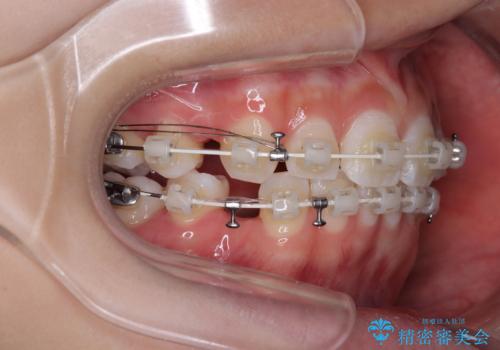 斜め前に飛び出した前歯 抜歯矯正で素敵な横顔にの治療中