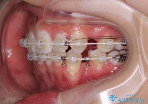斜め前に飛び出した前歯 抜歯矯正で素敵な横顔にの治療中